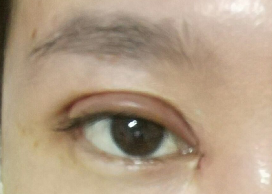 埋線雙眼皮可以維持幾年？