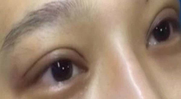 埋線雙眼皮大概能保持幾年?。柯窬€雙眼皮需要拆線嗎？