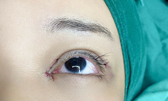 埋線雙眼皮消失怎么辦？