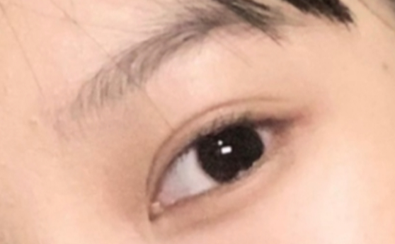 什么是雙眼皮定點？