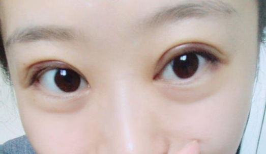 定點雙眼皮能維持幾年？