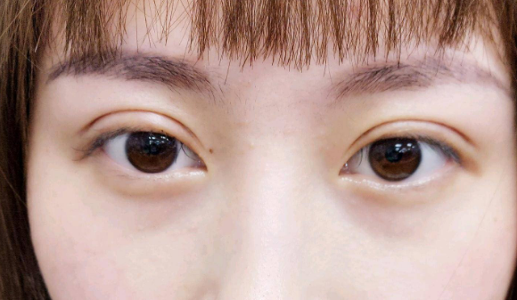 定點雙眼皮是什么意思？雙眼皮定點能維持多久？