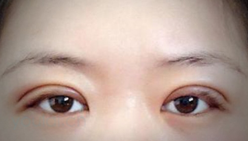 定點(diǎn)雙眼皮幾天能恢復(fù)好？