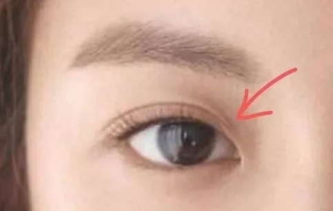 定點(diǎn)雙眼皮一般多少錢(qián)？