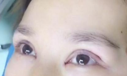 定點雙眼皮手術效果自然嗎？定點雙眼皮失敗怎么修復？