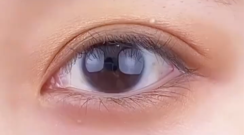 定點(diǎn)雙眼皮多少錢？