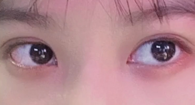 雙眼皮定點(diǎn)能維持多久？