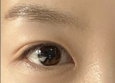 割雙眼皮后自然嗎？割雙眼皮后有危害嗎？