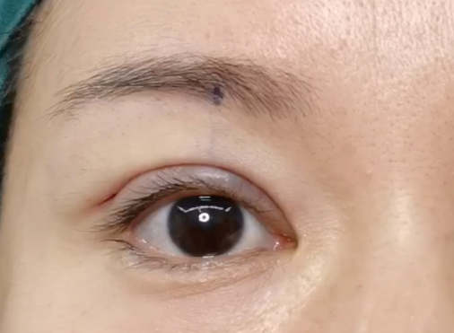 割雙眼皮后有危害嗎？