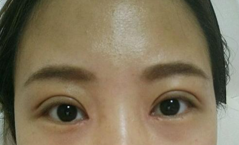 定點(diǎn)雙眼皮會(huì)腫嗎？定點(diǎn)雙眼皮會(huì)有疤痕嗎？