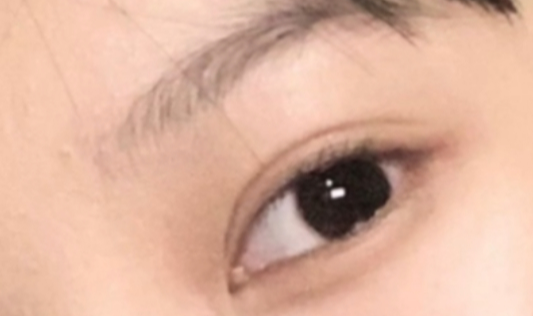 割雙眼皮恢復(fù)需要多久？