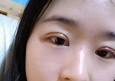 割雙眼皮后眼睛會(huì)變大嗎？