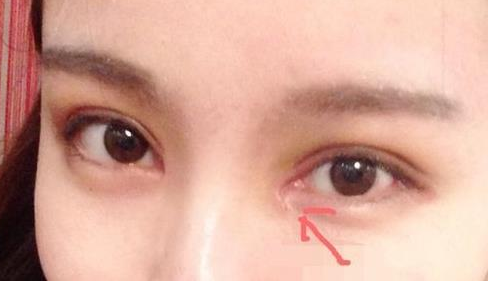 單眼皮開(kāi)內(nèi)眼角會(huì)留疤嗎？