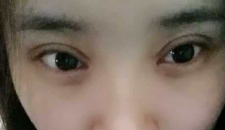 開眼角疼嗎？