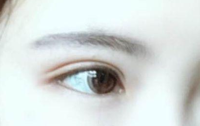 開眼角的恢復(fù)期多長？開眼角的后遺癥都有什么？