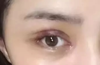 韓式開眼角失敗了怎么辦？