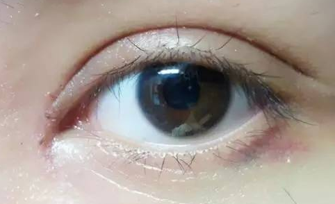 韓式開眼角好嗎？韓式開眼角術(shù)后怎么護(hù)理？