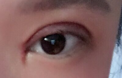 韓式開眼角手術有哪些優(yōu)勢？