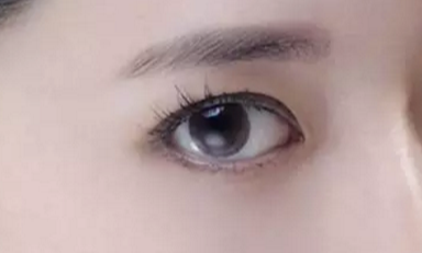 韓式開眼角的手術(shù)費用是多少？