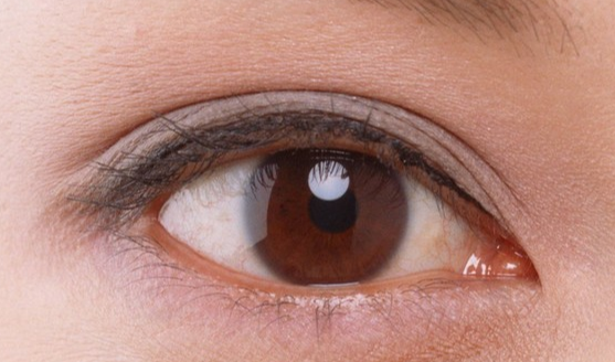 韓式開眼角安全嗎？韓式開眼角半個(gè)月能消腫嗎？