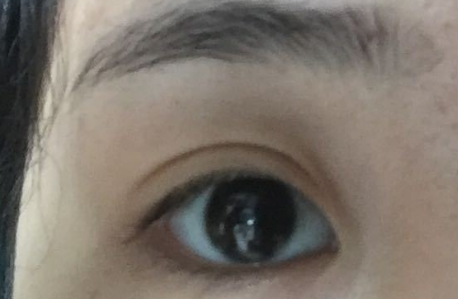 開(kāi)內(nèi)眼角拆線后變化明顯嗎？