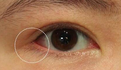 開內(nèi)眼角可能會出現(xiàn)什么后遺癥？