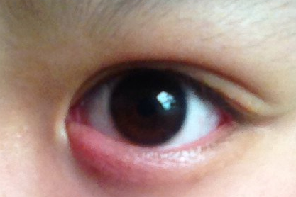 開內(nèi)外眼角的缺點有哪些？