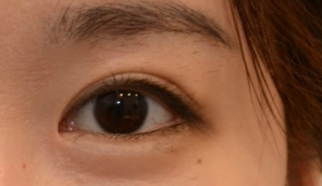 開個(gè)外眼角手術(shù)有多大風(fēng)險(xiǎn)？