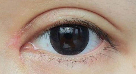 開(kāi)眼角術(shù)后如何護(hù)理？