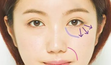 開內(nèi)外眼角的效果如何？