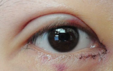 開內(nèi)眼角過程中會(huì)疼嗎？開內(nèi)眼角的風(fēng)險(xiǎn)有哪些？