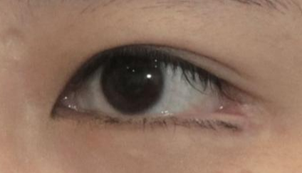 開內(nèi)眼角都會回縮嗎？