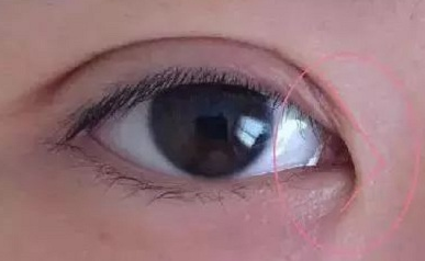 開內(nèi)眼角的作用有哪些？