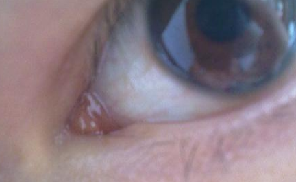 開內(nèi)外眼角需要注意什么？