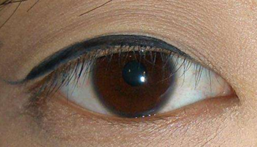 開內(nèi)眼角的風(fēng)險(xiǎn)有哪些？