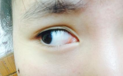 開內(nèi)眼角多久可以回縮？開內(nèi)眼角多久能消腫？