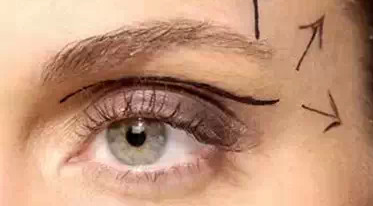 開(kāi)內(nèi)外眼角需要幾次？