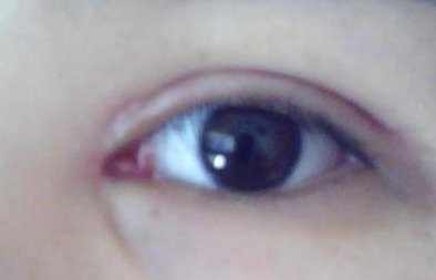 開(kāi)內(nèi)外眼角效果怎么樣？