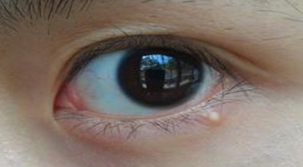 開內(nèi)外眼角手術是永久的嗎？