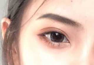 開內(nèi)外眼角怎么消腫快？開內(nèi)外眼角有什么壞處？