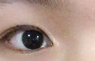 開內(nèi)眼角的危害有哪些？