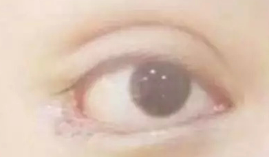 開內(nèi)眼角的效果好嗎？