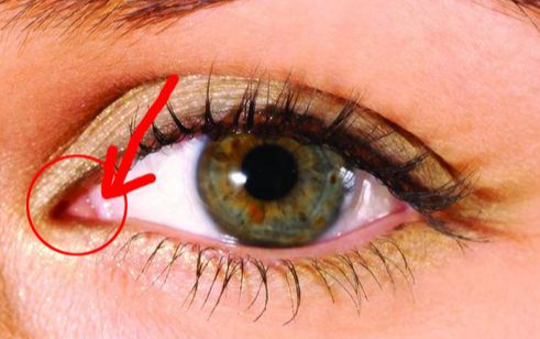 開內(nèi)外眼角怎么消腫？開內(nèi)外眼角是怎么做的？