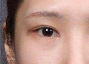 開內(nèi)外眼角腫幾天？