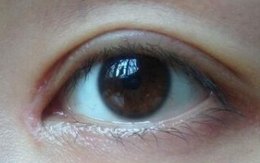 開內眼角的禁忌癥是什么？