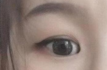 開內眼角的手術費用多少？