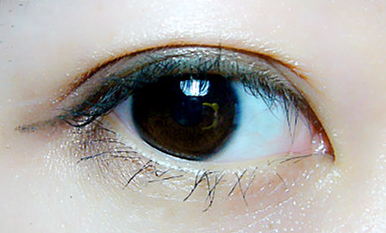 開內(nèi)眼角怎么避免并發(fā)癥？