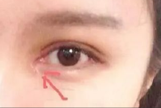 開眼角割雙眼皮拆線嗎？術(shù)后拆線疼嗎？