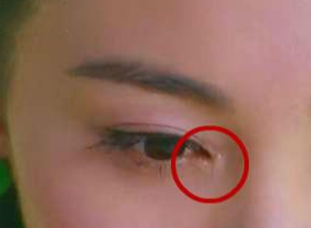 開(kāi)眼角要增生多久？