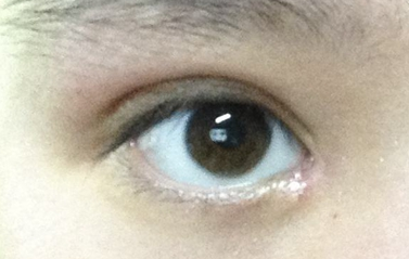 開眼角一定會出現疤痕嗎？